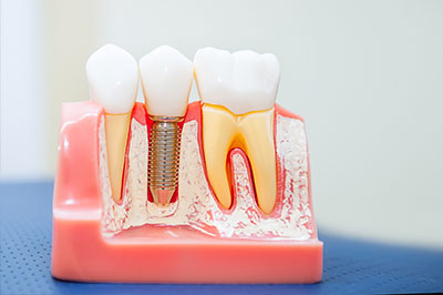 The image shows a dental model with artificial teeth and gums, featuring a close-up of the teeth with visible fillings and an implant, set against a blue background.